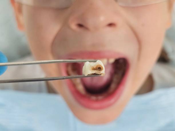 Best Emergency Broken Tooth Repair in Lumber City, GA